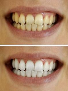 7 Ways to Naturally Whiten Your Teeth