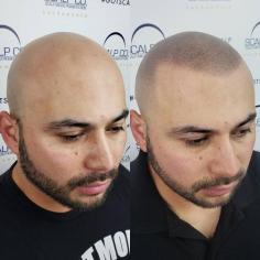Scalp Co. Scalp Micro Pigmentation

Here at Scalp Co. SMP we specialize in the art of Scalp Micropigmentation. Using a micro needle we replicate your natural hair follicle pattern so that we may best create the full illusion of a shaved or cropped head of hair.

Address: 716 10th St, STE 100, Sacramento, CA 95814, USA
Phone: 916-793-5404
Website: https://www.gotscalp.com
