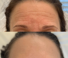 Discover the transformative effects of dermal fillers with our Dermal Fillers Before and After Face gallery. See real results and how dermal fillers can enhance your appearance. Explore the possibilities and find out more at Allie Aesthetics. Experience beauty with confidence!